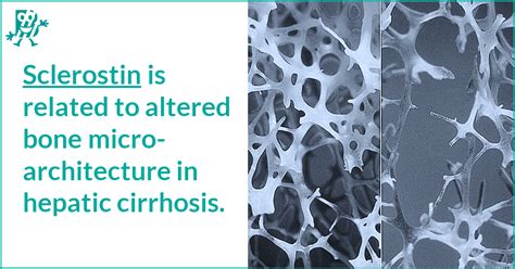 Sclerostin is related to altered bone microarchitecture in hepatic ...