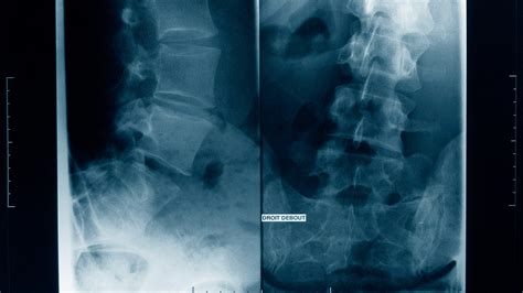 What is scoliosis? Causes and symptoms of the spinal condition ...