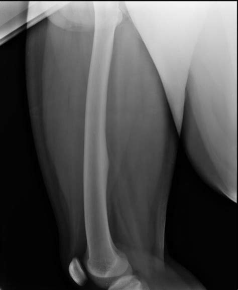 Osteoid Osteoma Diagnosis and Treatment | Bone and Spine