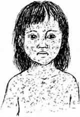 Measles Drawing Getdrawings Sketch Coloring Page sketch template