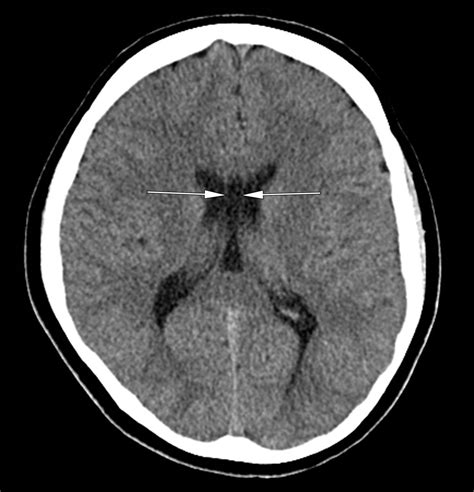 Cavum septum pellucidum as seen on an axial CT (normal variant ...