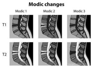 Modic Type II Endplate Changes - And Its Impact On Back Pain