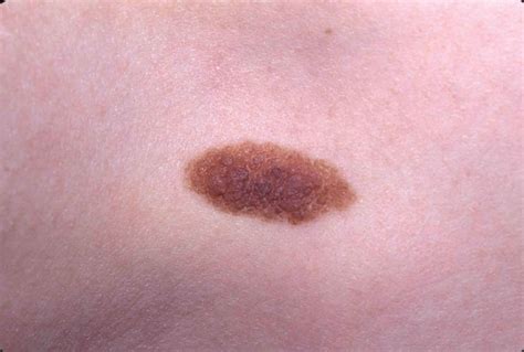 Nevus definition, types, diagnosis & nevus treatment