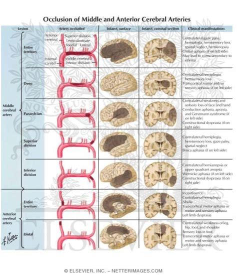 Occlusion of Middle and Anterior Cerebral Arteries