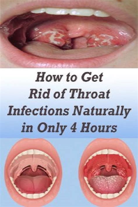 Instructions to Get Rid of Throat Infections Naturally in Only 4 Hours - articleremedies34