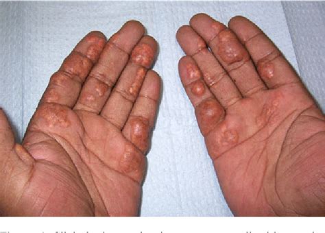 Figure 1 from Palmar Xanthoma—An Indicator of a More Sinister Problem | Semantic Scholar