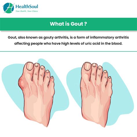 Signs Of Having The Gout - GoutInfoClub.com