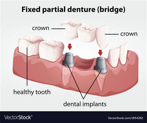 Fixed Partial Dentures
