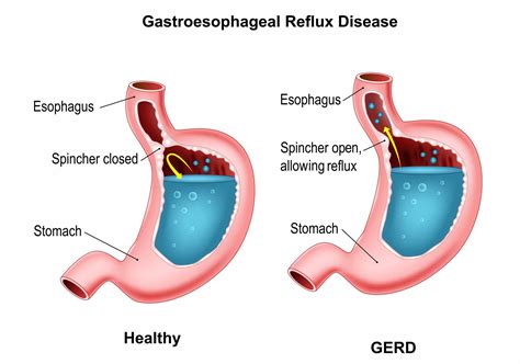 Hiatal Hernia Surgery in Katy, TX | Dr. Clay Albrecht