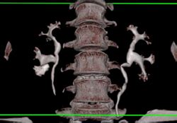 Blunted Lower Pole Calyx on the Right - Kidney Case Studies - CTisus CT Scanning