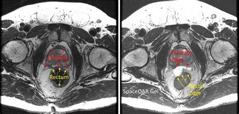 Side Effects Of External Beam Radiation Prostate Cancer - The Best ...