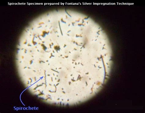 Pathology Tips : Spirochetes & Treponema palladium