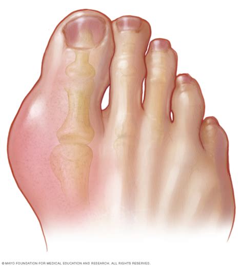 Gout Disease Reference Guide - Drugs.com