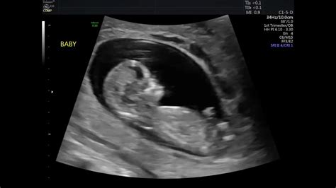 12 WEEK ULTRASOUND! MY BABY MOVING & HEARTBEAT! - YouTube