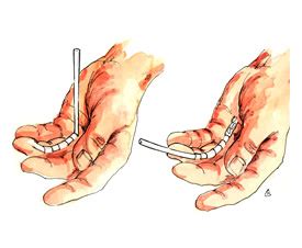 Flexor tendons – late reconstruction and grafting | Mr Donald Sammut ...