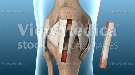 ViewMedica Stock Art: Patellar tendon graft for ACL reconstruction surgery