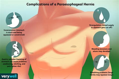 Paraesophageal Hiatal Hernia Complications