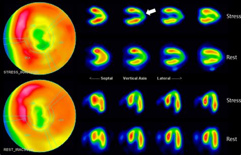 Myocardial perfusion SPECT imaging: SPECT scan showed medium-sized,... | Download Scientific Diagram