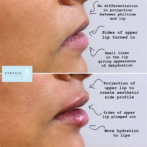 Enhance by Tara on Instagram: "A natural looking lip enhancement using ...