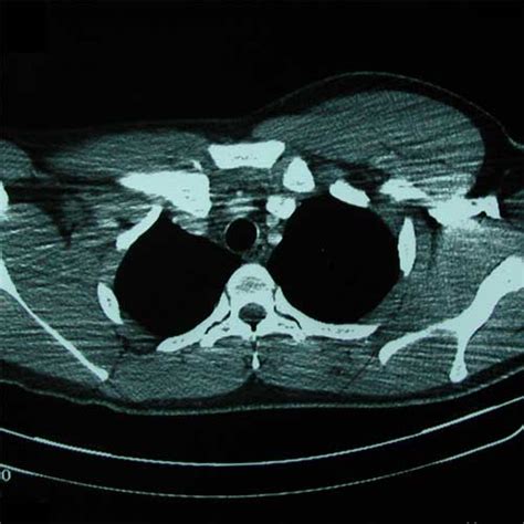 Sternoclavicular Joint Dislocation S43.206A 839.61 | eORIF