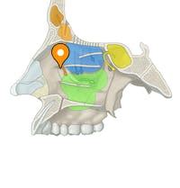 Ethmoidal infundibulum - e-Anatomy - IMAIOS