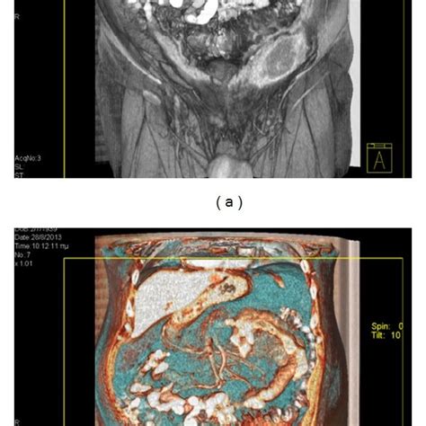 Photograph of the abdominal wall abscess after surgical drainage ...