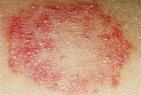 Fungal Skin Infections: Types, Symptoms, and Treatments