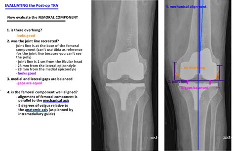 Knee Replacement Xray