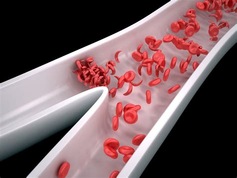 10 Symptoms of Sickle Cell Anemia - Facty Health