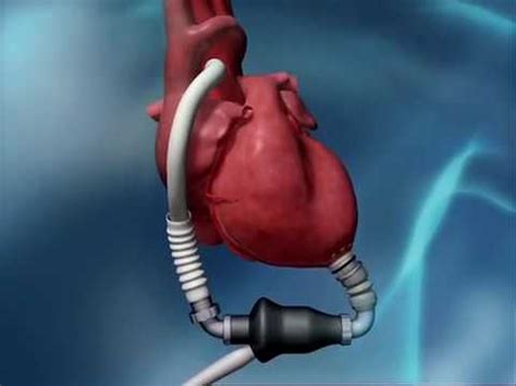 Medical Device Animation: Heartware System LVAD Pump | lvad คือ – Webgiasi.vn – Siêu thị bán sỉ ...