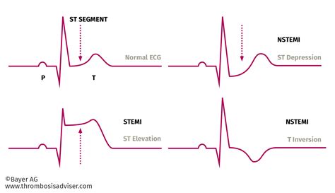 Introduction to ACS | Thrombosis Adviser