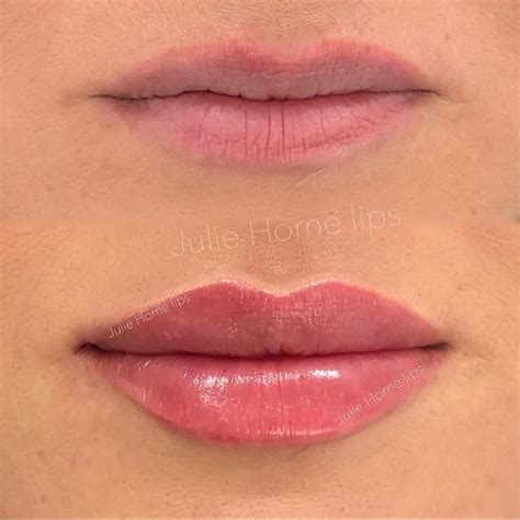 Restylane Lip Filler After Care