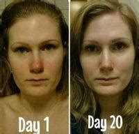 Phymatous Rosacea » Rhinoplasty: Cost, Pics, Reviews, Q&A