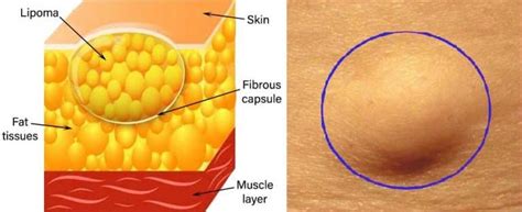 Lipoma - Skin Condition - Causes, Symptoms, Diagnosis and Treatments