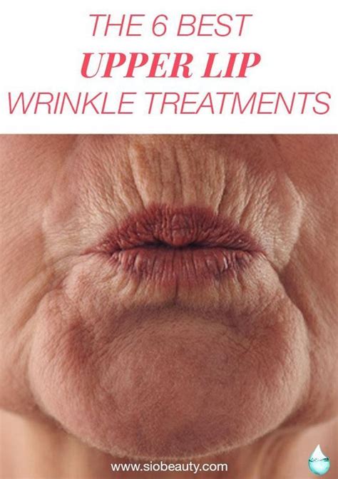 Tips to help get rid of smoker's lines – Lip lines or Lip wrinkles treatments #siobeauty # ...