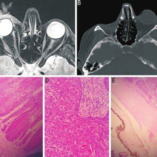 (PDF) Characteristics, management, and outcome of squamous carcinoma of ...