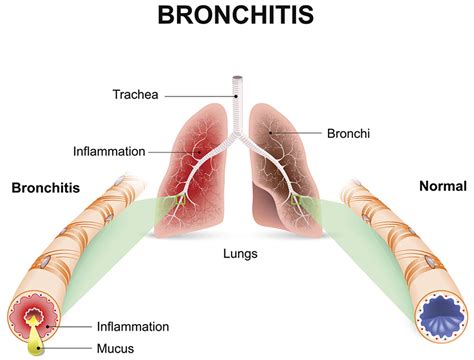 Acute and Chronic Bronchitis - Causes, Symptoms and Treatment