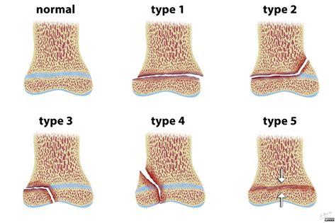 Salter-Harris illustrations | Radiology Case | Radiopaedia.org | Radiology, Pediatric patients ...