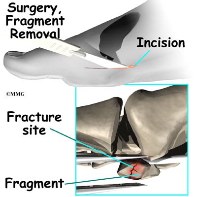 Sesamoid | eOrthopod.com