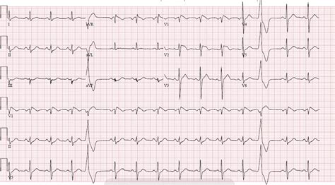 Type 1 Brugada Syndrome, ECG. JETem 2018 - JETem