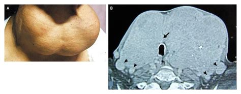 Endemic Multinodular Goiter | NEJM