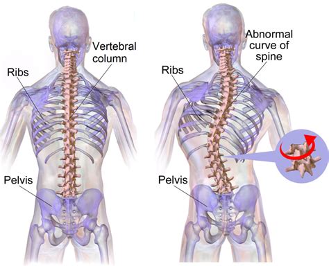 Pilates and Scoliosis - here's my story - Pebbles Pilates