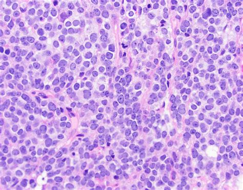 neuropathology blog: Pineal Parenchymal Tumor of Intermediate Differentiation, WHO grade III