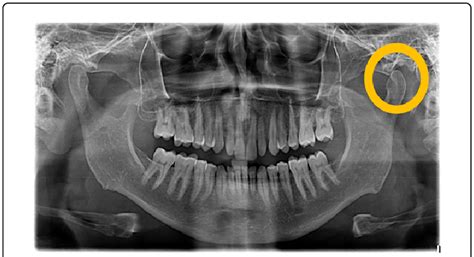 Dislocated Jaw X Ray