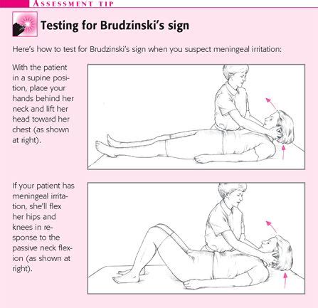 brudzinski's sign - Google Search | All things nurse-y | Pinterest ...