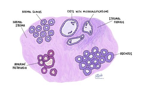 Fibrocystic change of the breast | MyPathologyReport.ca