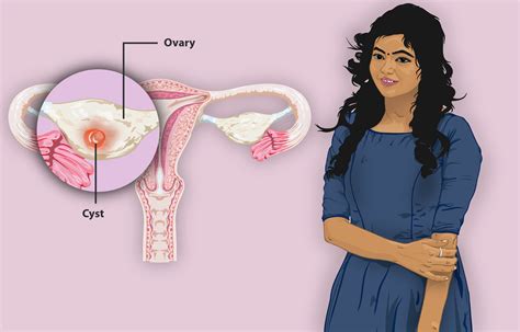 Ovarian Cyst Symptoms > Laparoscopycures