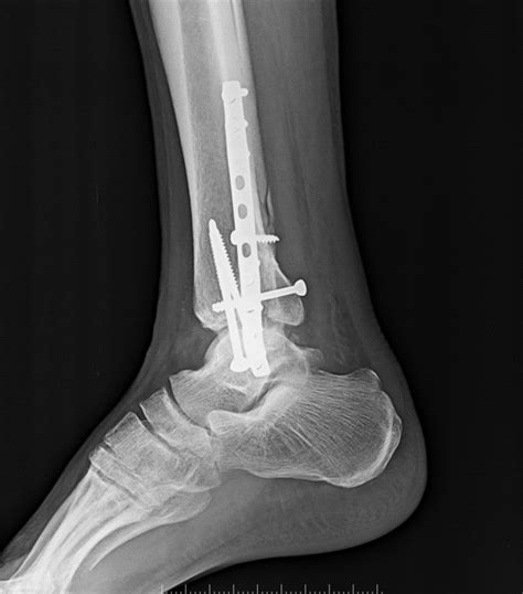 ANKLE FRACTURE FIXED | Buyxraysonline