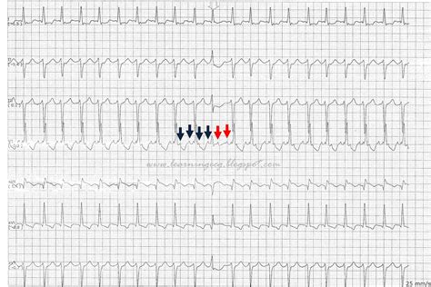 ECG Rhythms: Atrial Flutter