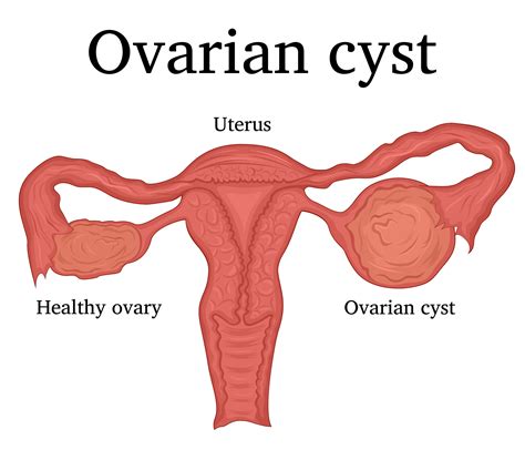 Ovarian Cyst: Causes and Symptoms - Apollo Hospitals Blog